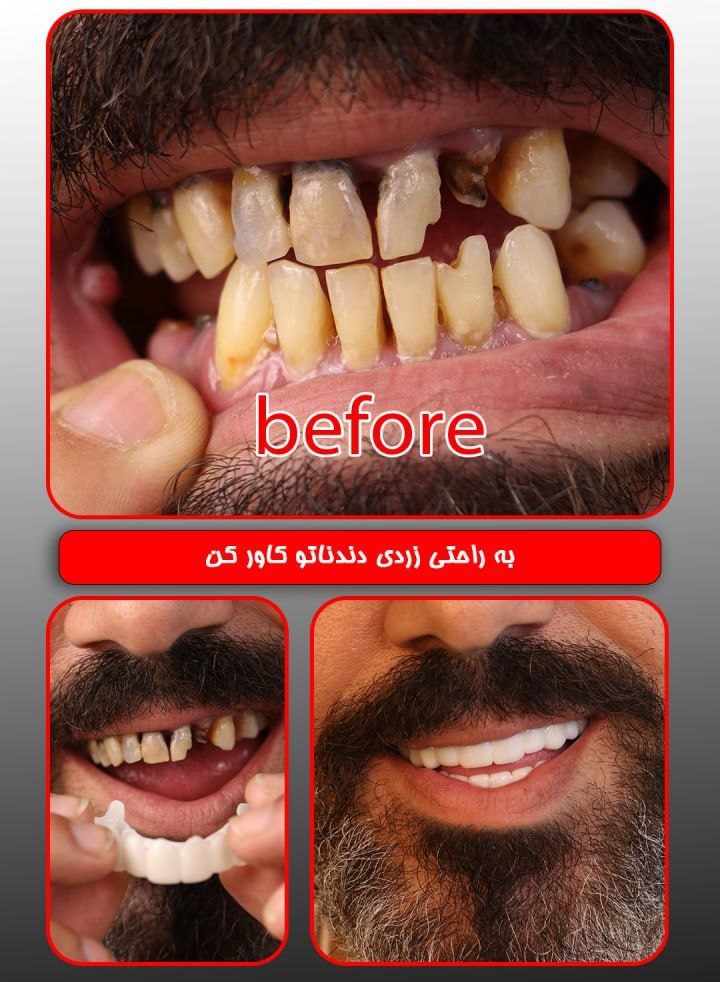  لمینت دندان دو فک اصلی برای خرابی 4 دندان vision 4 دکترفروش